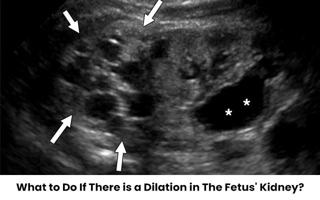 What to Do if There is a Dilation in The Fetus’ Kidney?