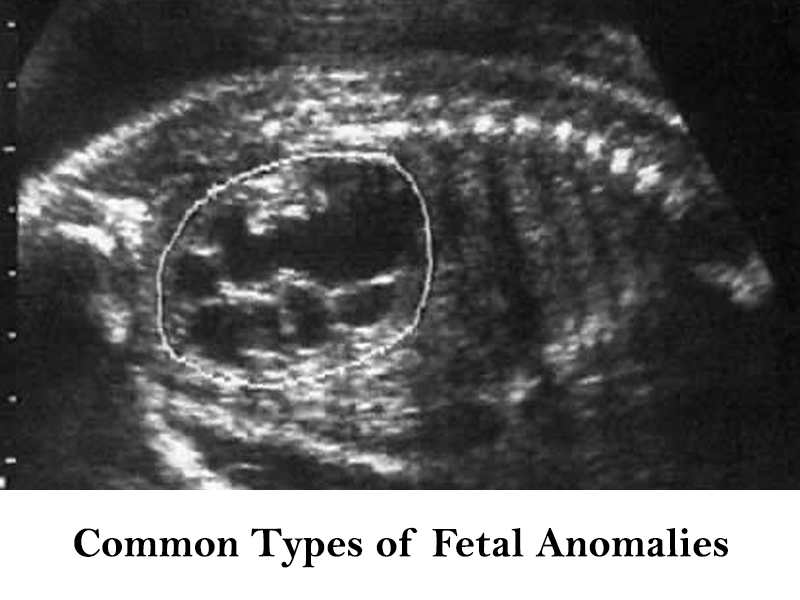 Common Types of Fetal Anomalies